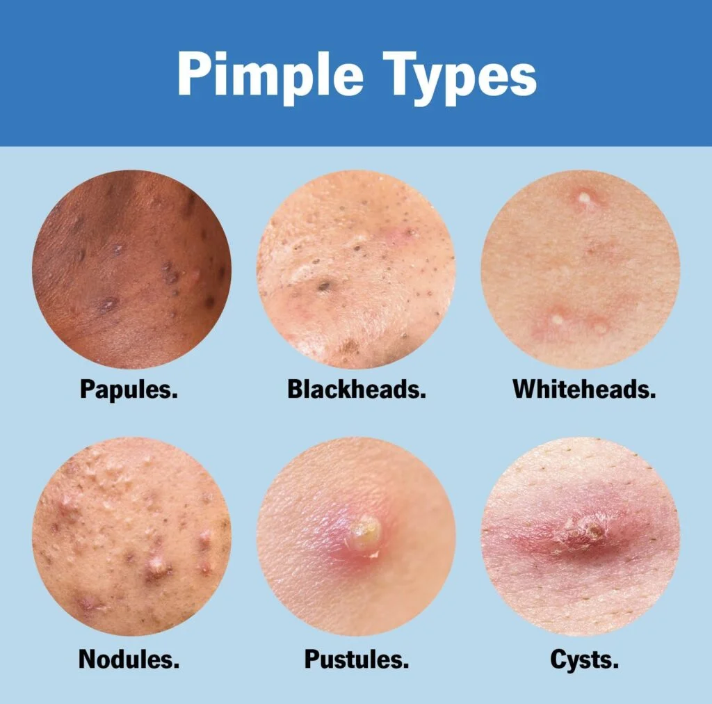 Dealing with Pimples: Causes and Effective Treatment