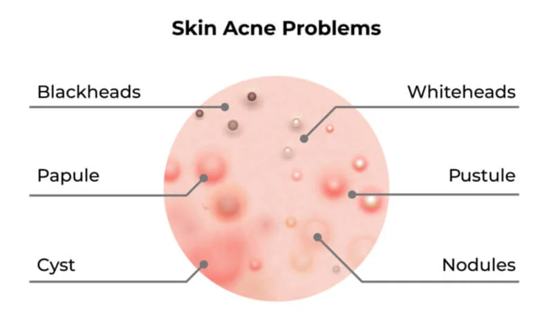 Dealing with Pimples: Causes and Effective Treatment