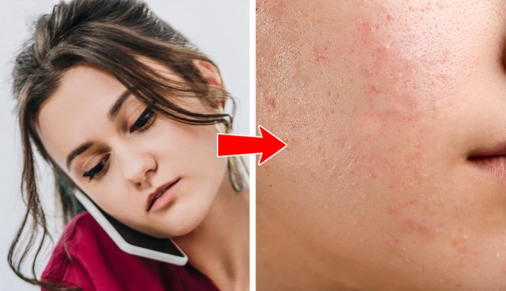 Why Acne Appears on These 8 Body Areas, and What You Should Do