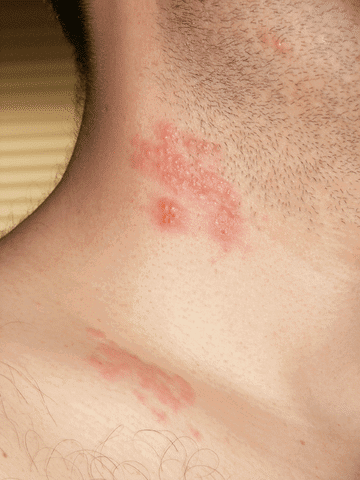 Skin Conditions