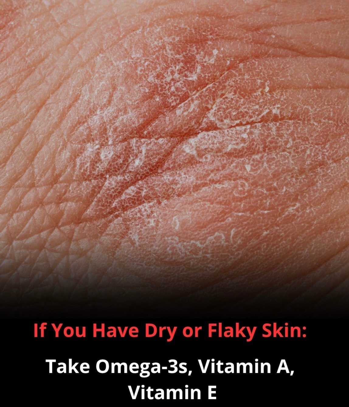 Canker Sores Protocol